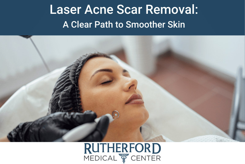 Laser Acne Scar Removal: A Clear Path to Smoother Skin