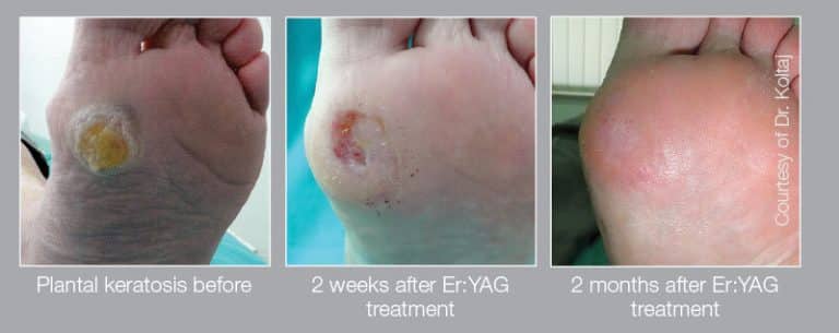 keratosis 768x305 1