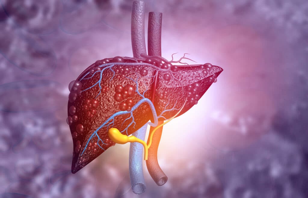 FDA Approves Wegovy for Severe Liver Disease: First GLP-1 Treatment for MASH